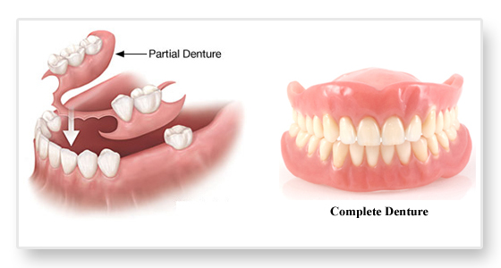 Dentures Dentures