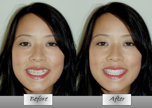 Before and After - Fixed Smile Before and After - Fixed Smile
