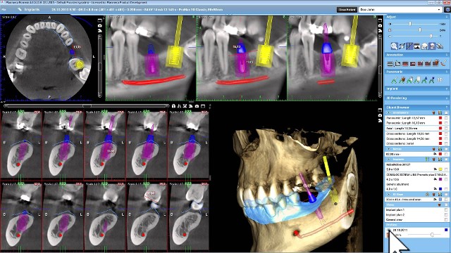Digital Xray