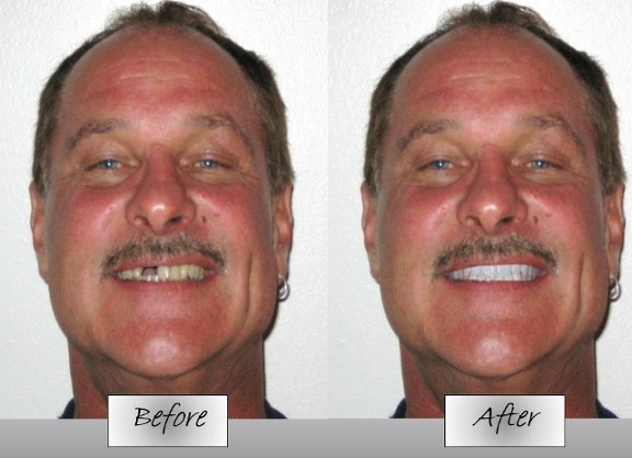 Before and After - Gap Fix
