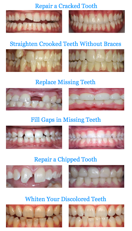 Teeth Before and After Teeth Before and After