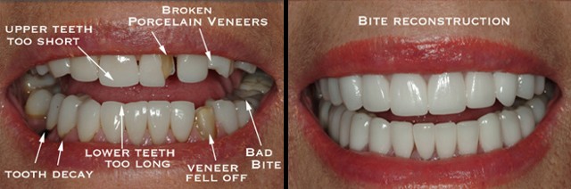 Reconstruction Before and After Reconstruction Before and After