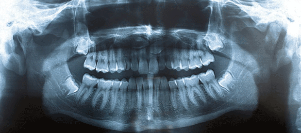 Mouth Xray